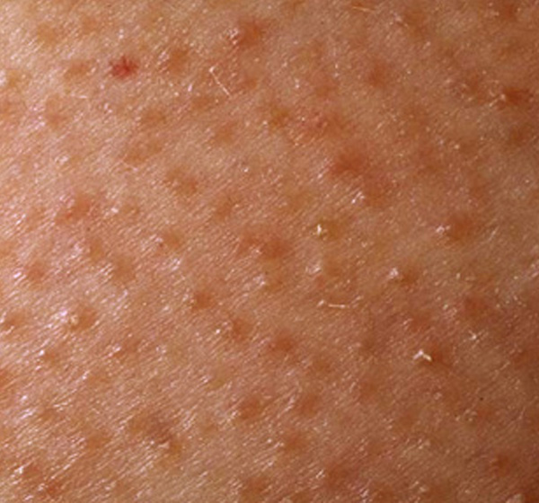 Actinic Keratosis Symptoms, Diagnosis, Prognosis And Treatment